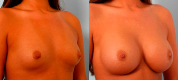 Breast Augmentation before and after photos in Houston, TX, Patient 26044