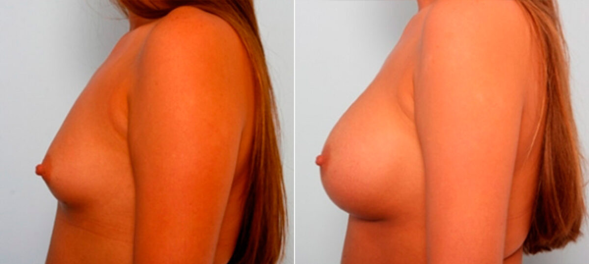 Breast Augmentation before and after photos in Houston, TX, Patient 26044