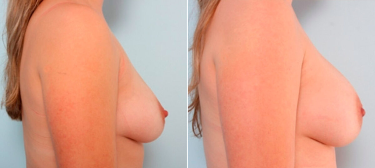Breast Augmentation before and after photos in Houston, TX, Patient 26055