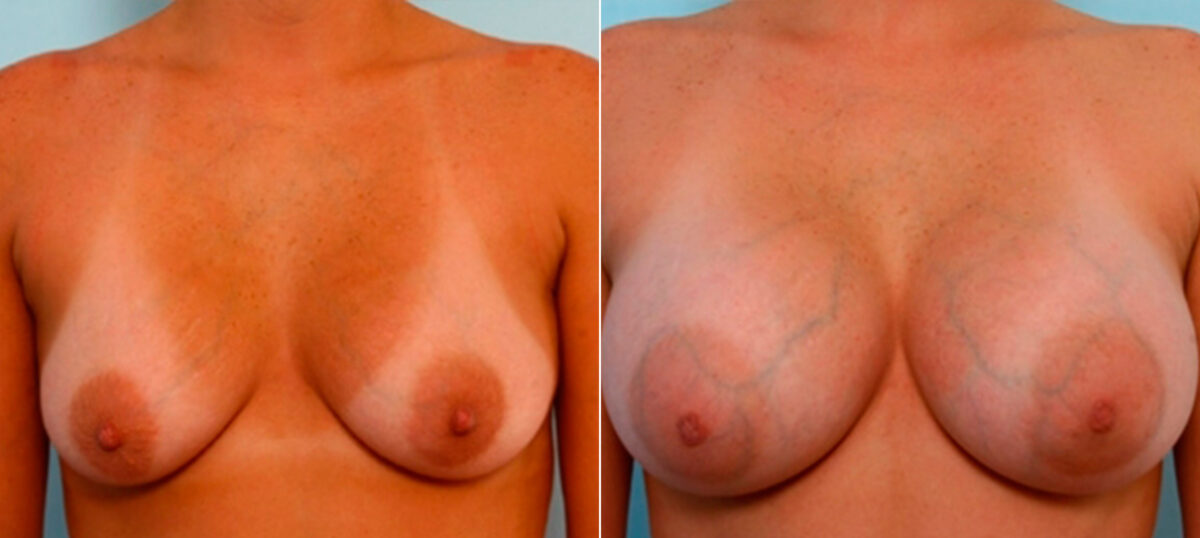 Patient 26066, Breast Augmentation before and after photos Breast Augmentation before and after photos in Houston, TX, Patient 26066