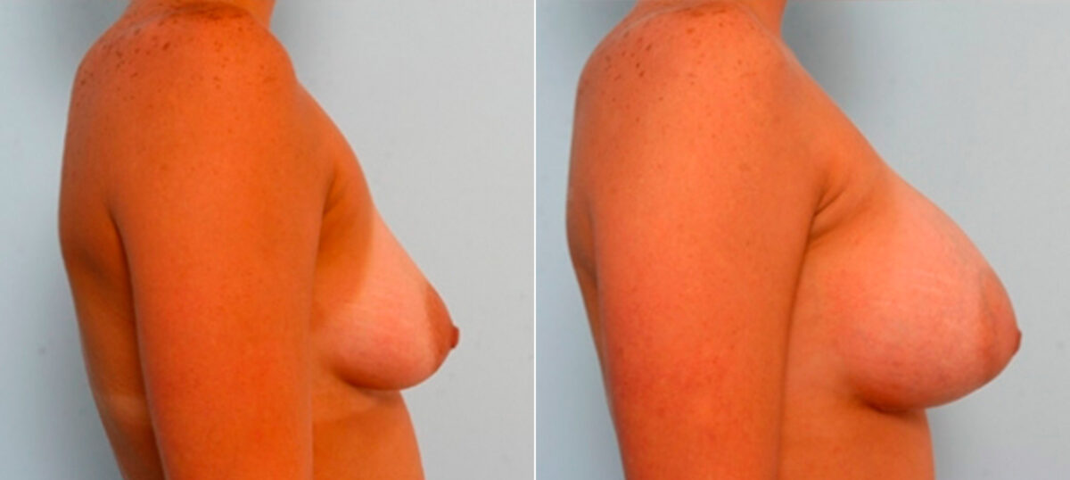 Breast Augmentation before and after photos in Houston, TX, Patient 26066