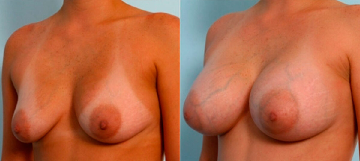 Breast Augmentation before and after photos in Houston, TX, Patient 26066