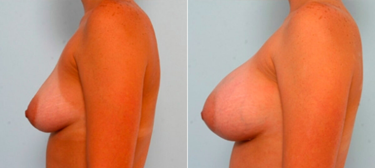 Breast Augmentation before and after photos in Houston, TX, Patient 26066