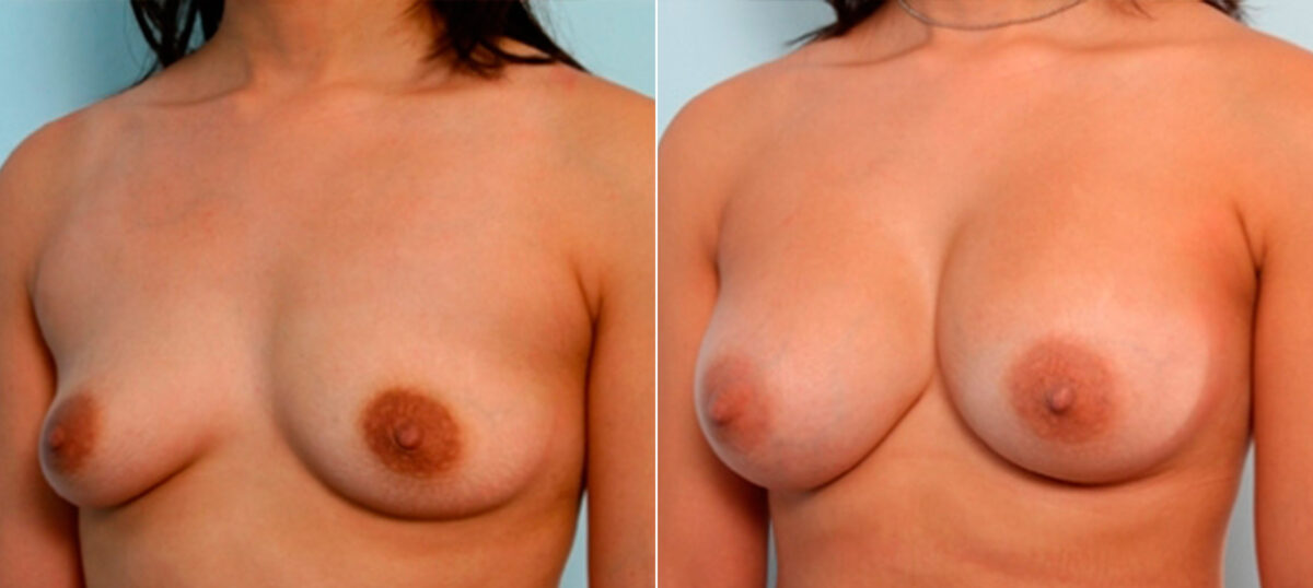 Breast Augmentation before and after photos in Houston, TX, Patient 26077