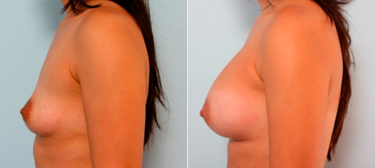 Breast Augmentation before and after photos in Houston, TX, Patient 26077