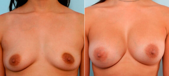 Breast Augmentation before and after photos in Houston, TX, Patient 26077