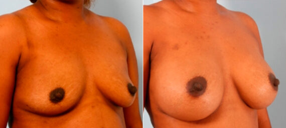 Breast Augmentation before and after photos in Houston, TX, Patient 26088