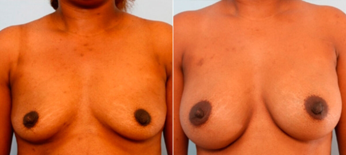 Patient 26088, Breast Augmentation before and after photos Breast Augmentation before and after photos in Houston, TX, Patient 26088
