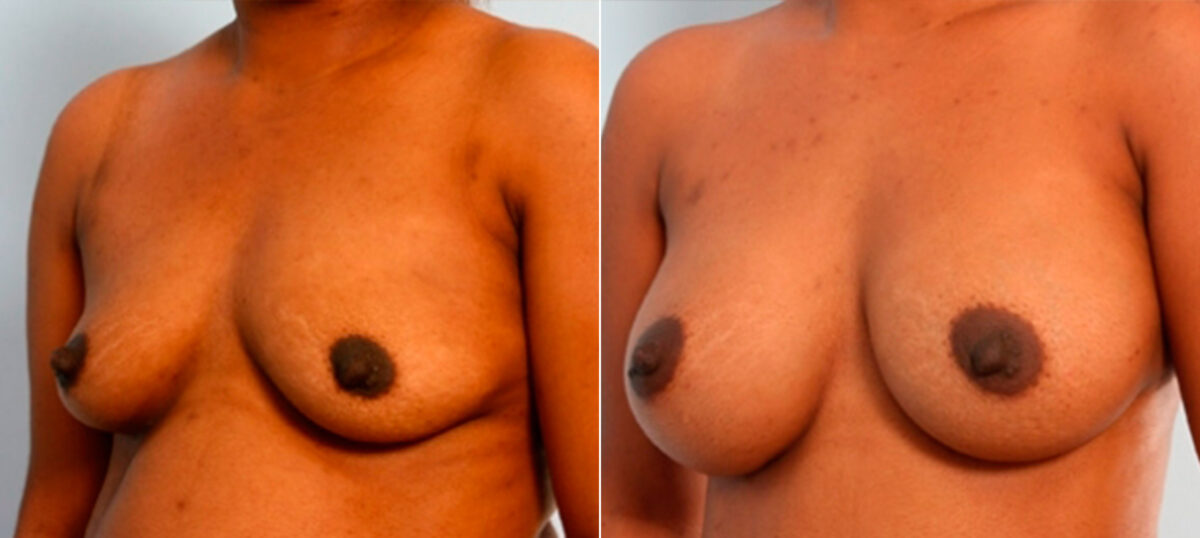 Breast Augmentation before and after photos in Houston, TX, Patient 26088