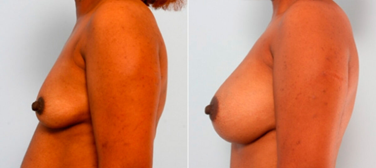 Breast Augmentation before and after photos in Houston, TX, Patient 26088