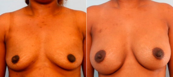 Breast Augmentation before and after photos in Houston, TX, Patient 26088