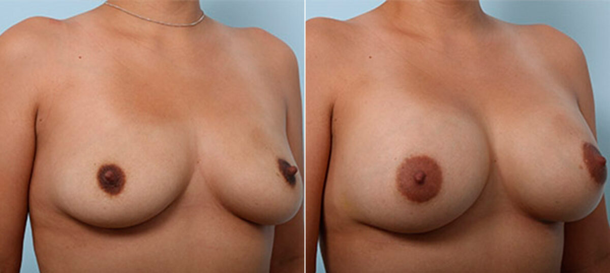 Breast Augmentation before and after photos in Houston, TX, Patient 26099