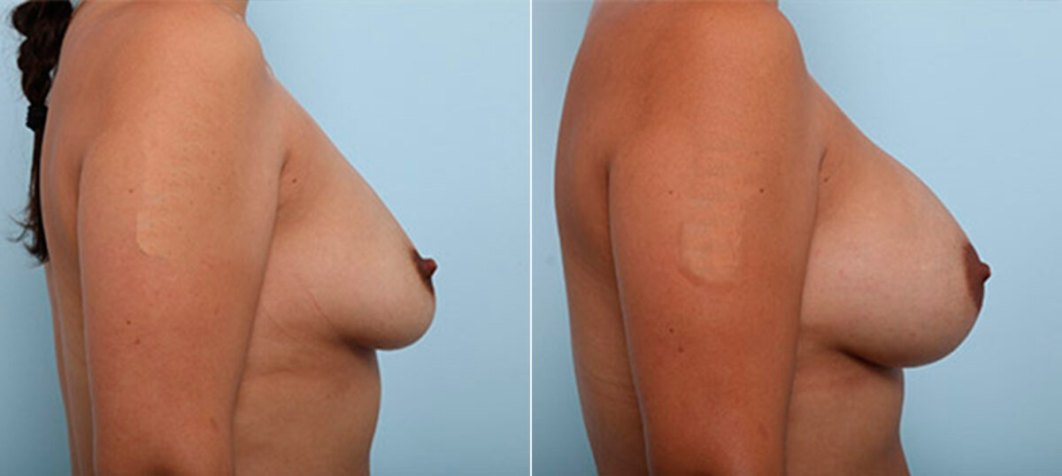 Breast Augmentation before and after photos in Houston, TX, Patient 26099