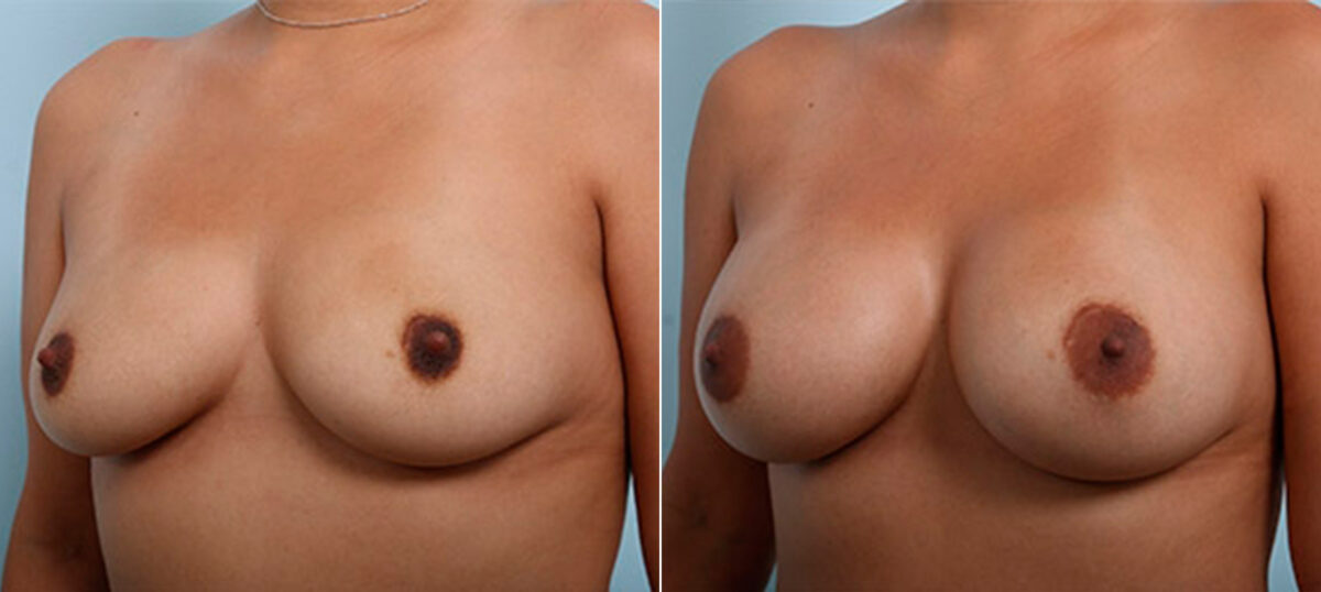 Breast Augmentation before and after photos in Houston, TX, Patient 26099