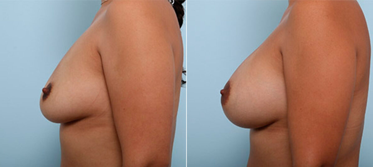 Breast Augmentation before and after photos in Houston, TX, Patient 26099