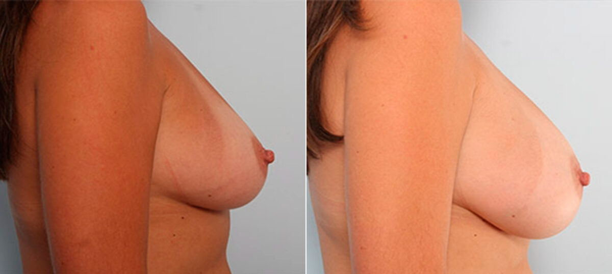 Breast Augmentation before and after photos in Houston, TX, Patient 26110