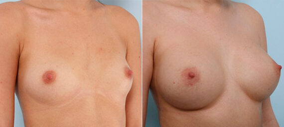Breast Augmentation before and after photos in Houston, TX, Patient 26121