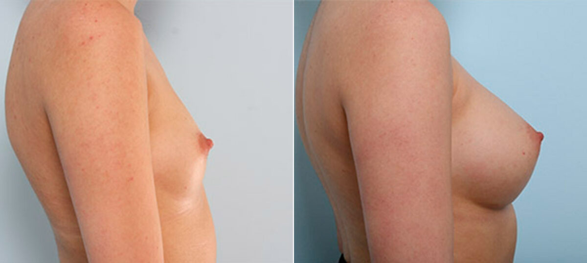 Breast Augmentation before and after photos in Houston, TX, Patient 26121