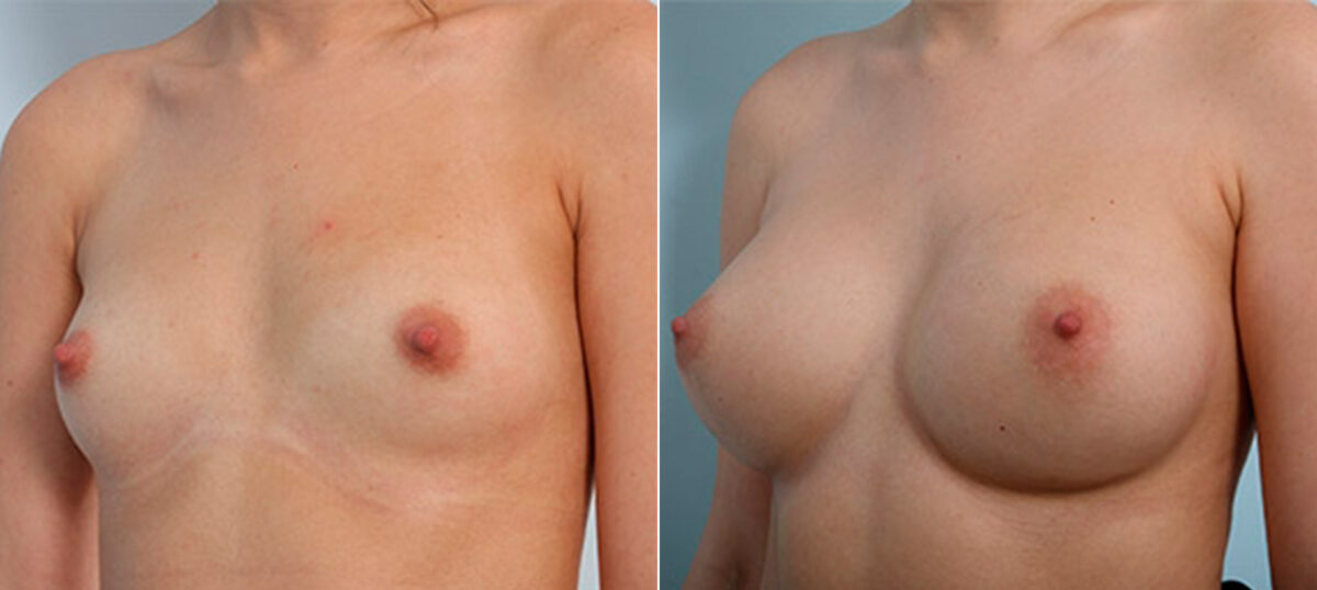 Breast Augmentation before and after photos in Houston, TX, Patient 26121