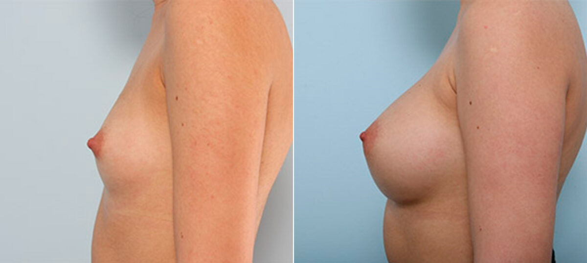 Breast Augmentation before and after photos in Houston, TX, Patient 26121