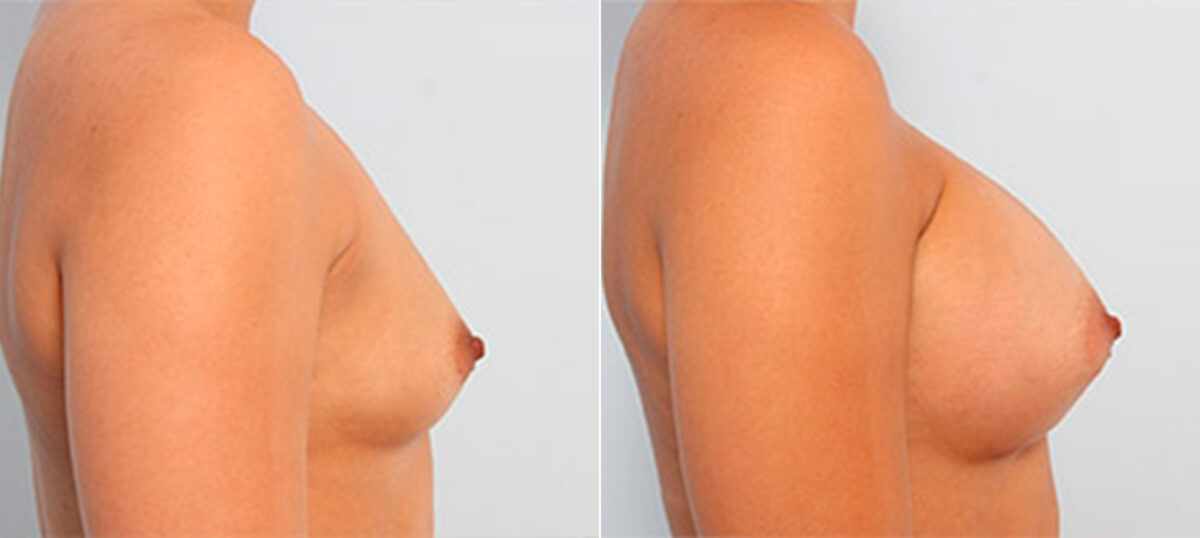 Breast Augmentation before and after photos in Houston, TX, Patient 26132