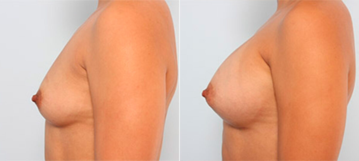 Breast Augmentation before and after photos in Houston, TX, Patient 26132