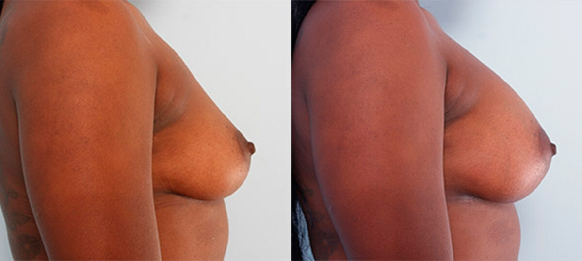 Breast Augmentation before and after photos in Houston, TX, Patient 26143