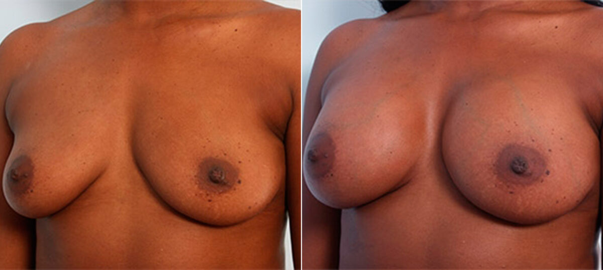 Breast Augmentation before and after photos in Houston, TX, Patient 26143