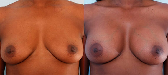 Breast Augmentation before and after photos in Houston, TX, Patient 26143