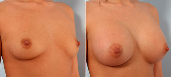 Breast Augmentation before and after photos in Houston, TX, Patient 26154