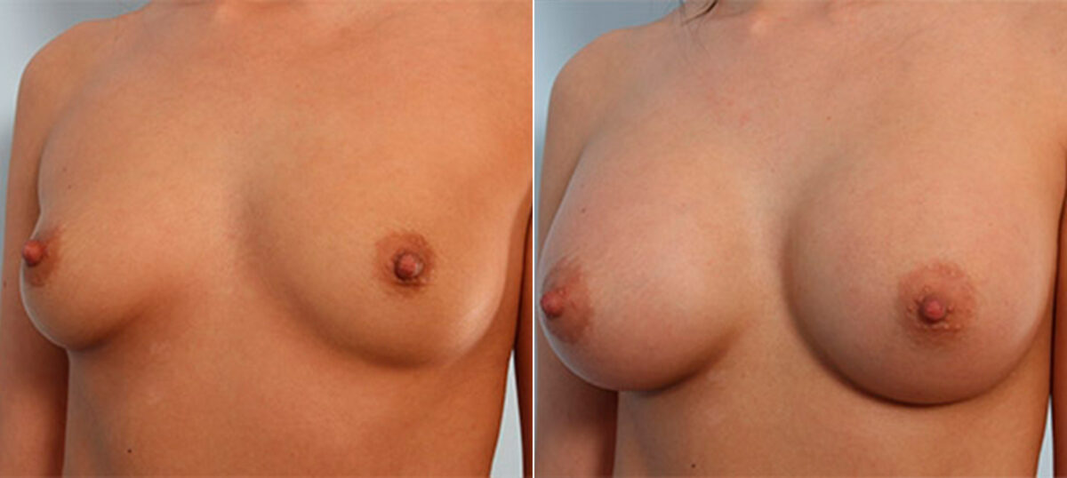 Breast Augmentation before and after photos in Houston, TX, Patient 26154