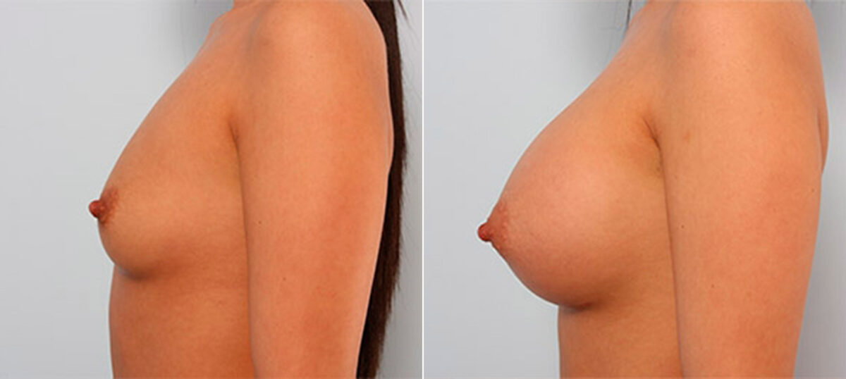 Breast Augmentation before and after photos in Houston, TX, Patient 26154