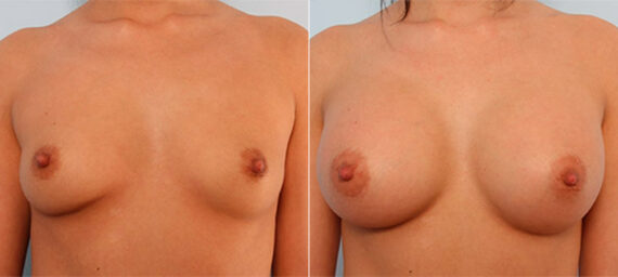 Breast Augmentation before and after photos in Houston, TX, Patient 26154