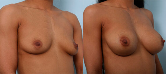 Breast Augmentation before and after photos in Houston, TX, Patient 26165
