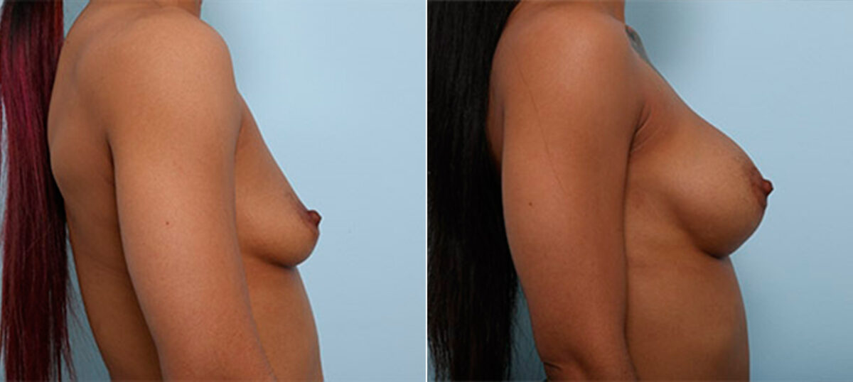 Breast Augmentation before and after photos in Houston, TX, Patient 26165