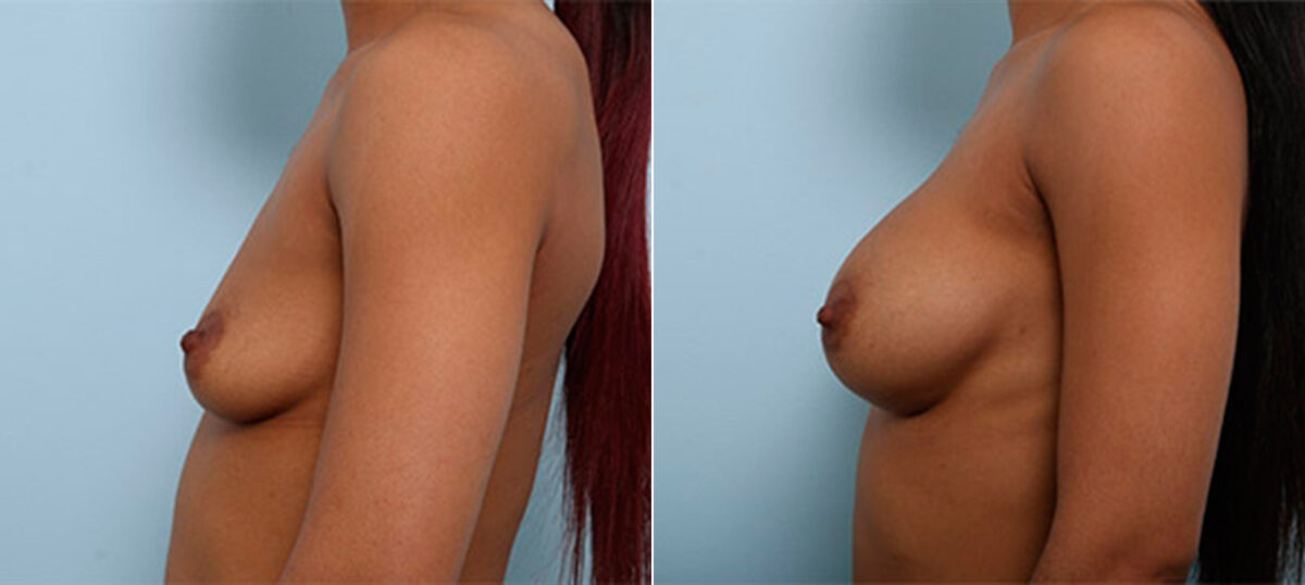 Breast Augmentation before and after photos in Houston, TX, Patient 26165