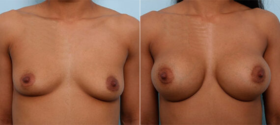 Breast Augmentation before and after photos in Houston, TX, Patient 26165