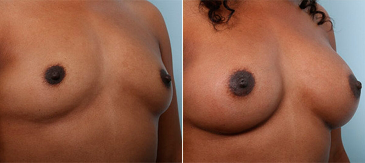 Breast Augmentation before and after photos in Houston, TX, Patient 26176