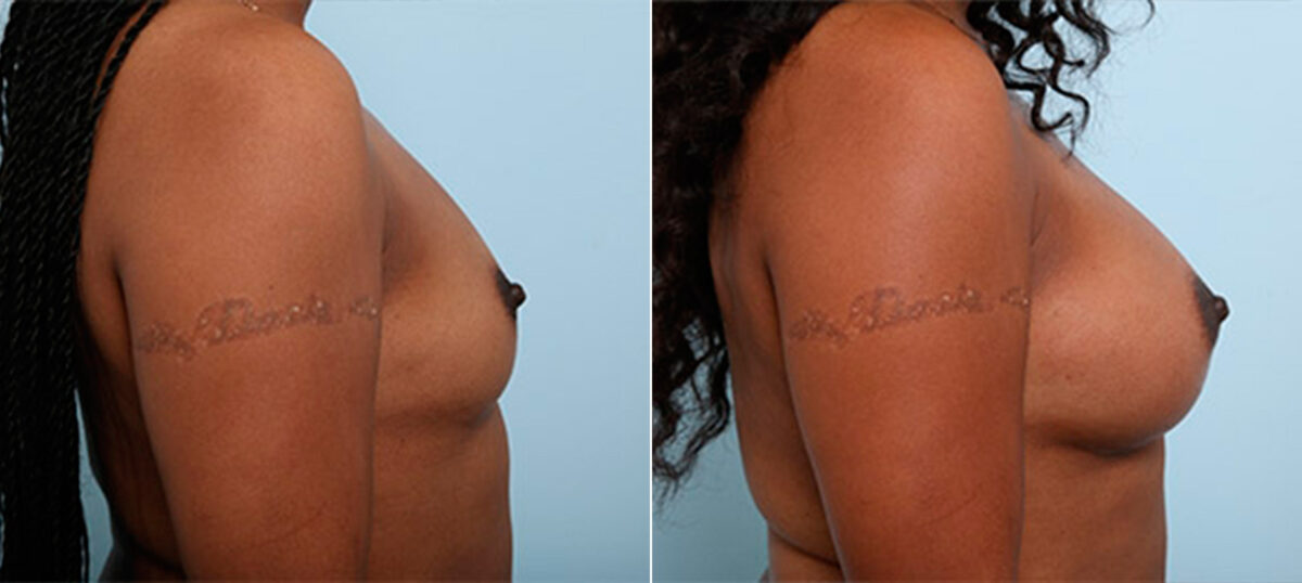 Breast Augmentation before and after photos in Houston, TX, Patient 26176