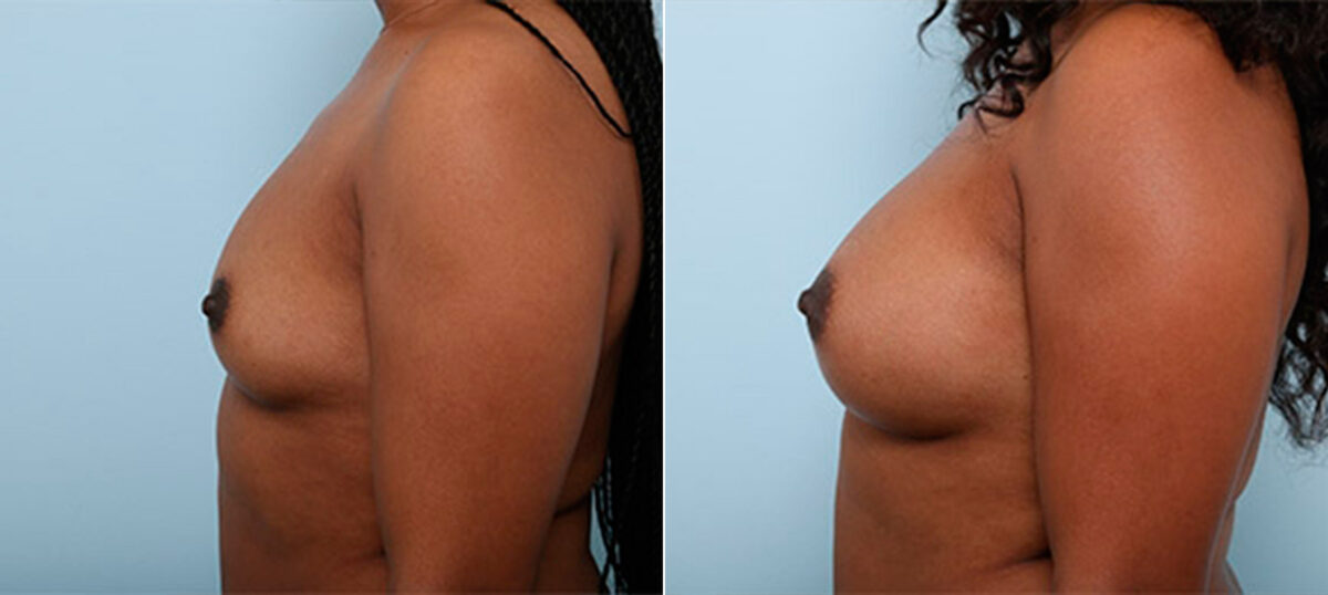 Breast Augmentation before and after photos in Houston, TX, Patient 26176