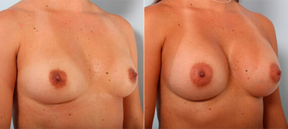 Breast Augmentation before and after photos in Houston, TX, Patient 26187