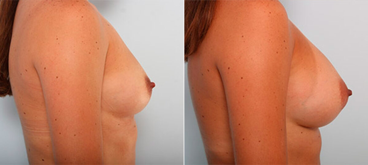 Breast Augmentation before and after photos in Houston, TX, Patient 26187