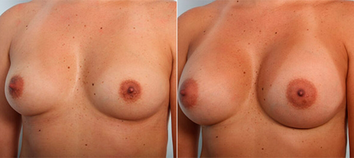 Breast Augmentation before and after photos in Houston, TX, Patient 26187