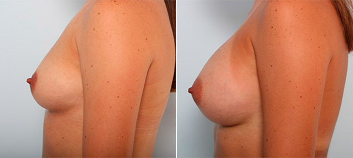 Breast Augmentation before and after photos in Houston, TX, Patient 26187