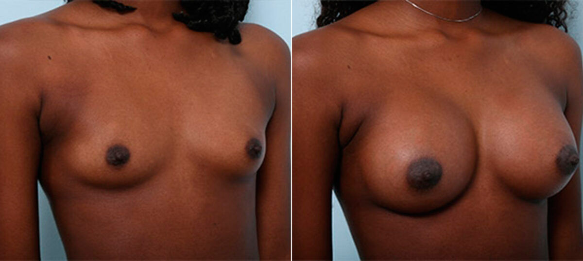 Breast Augmentation before and after photos in Houston, TX, Patient 26198
