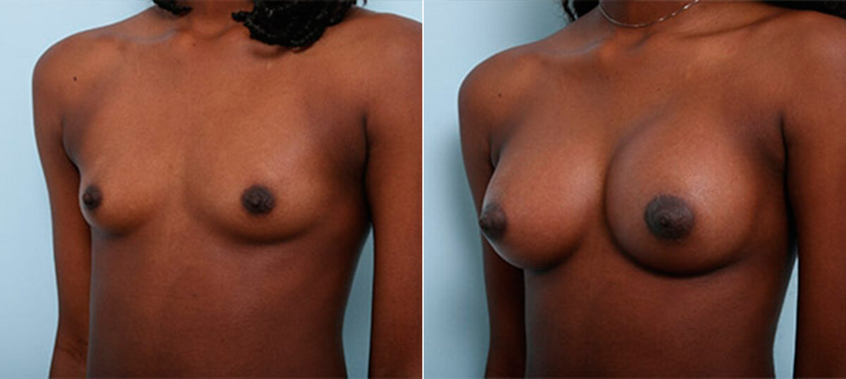 Breast Augmentation before and after photos in Houston, TX, Patient 26198