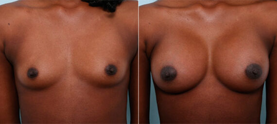 Breast Augmentation before and after photos in Houston, TX, Patient 26198