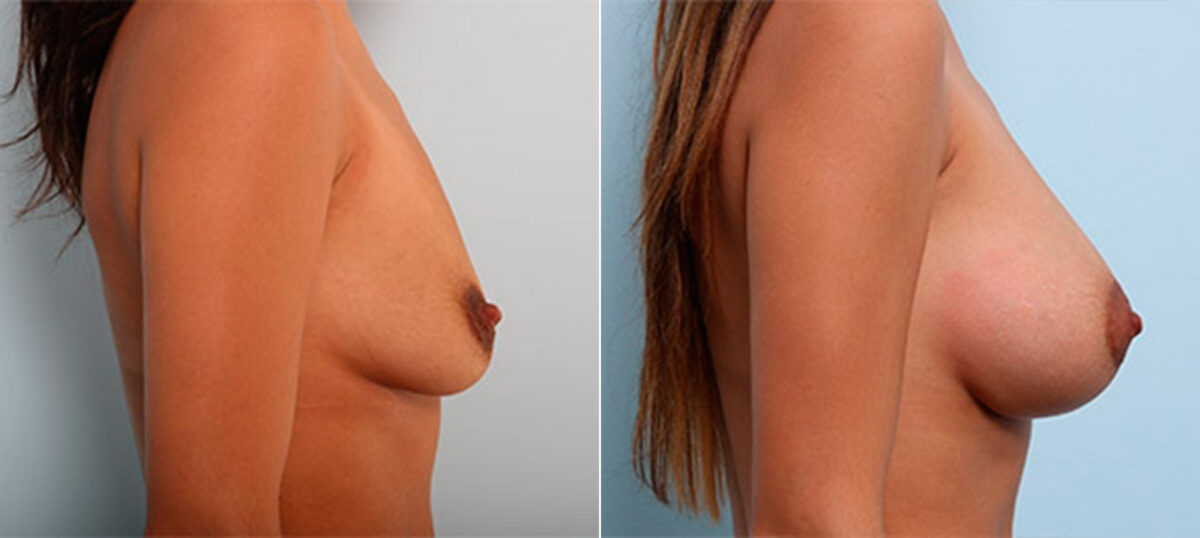 Breast Augmentation before and after photos in Houston, TX, Patient 26207