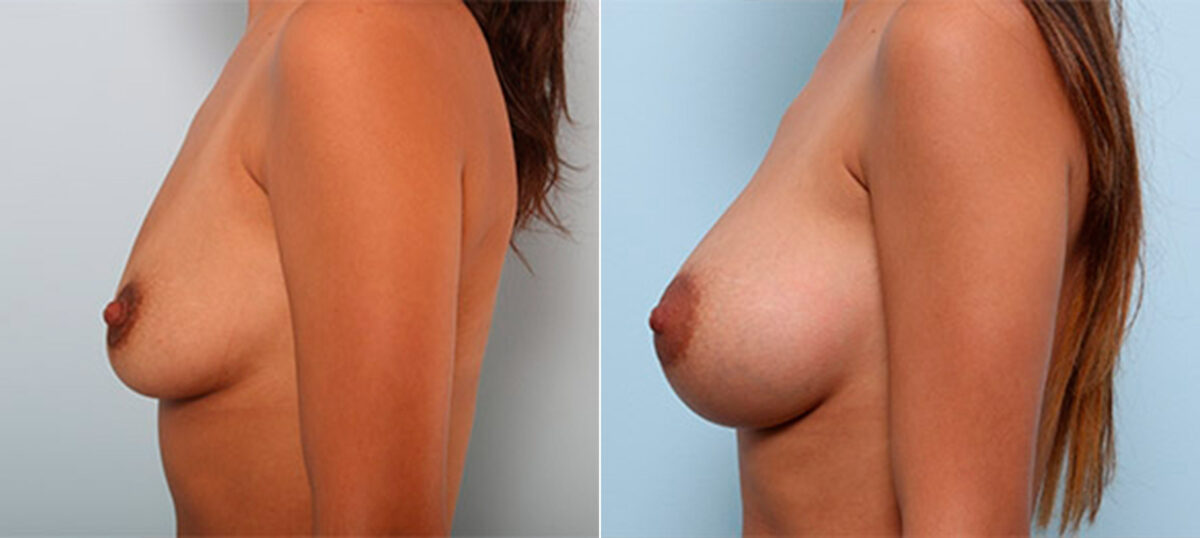 Breast Augmentation before and after photos in Houston, TX, Patient 26207