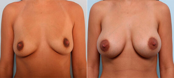 Breast Augmentation before and after photos in Houston, TX, Patient 26207